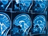 Thuật toán phân biệt tổn thương não: Công cụ mới rút ngắn thời gian chẩn đoán